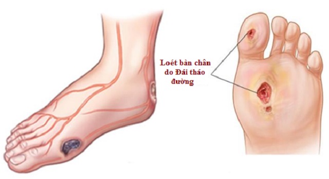 Tổn thương dây thần kinh ở ngoại biên cơ thể gây loét bàn chân
